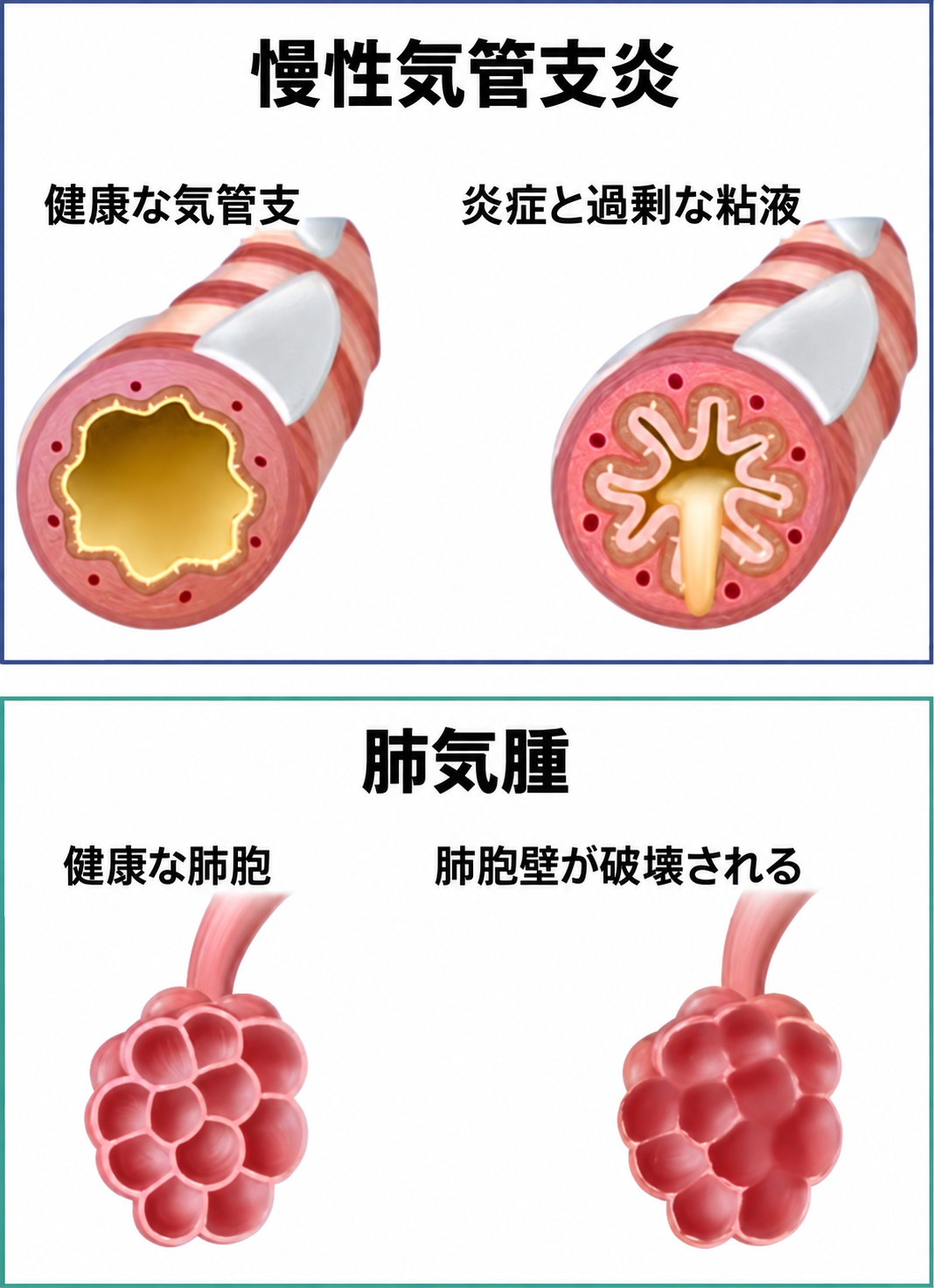 慢性気管支炎と肺気腫における気管支・肺胞の変化を示す図